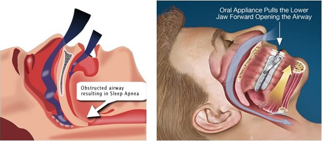 Obstructive Sleep Apnea Lebanon